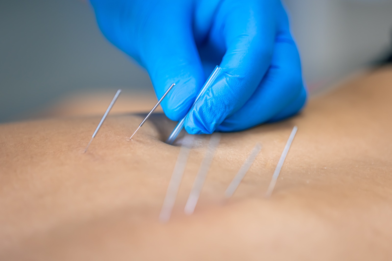 Dry Needling Certification